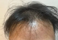レバクリの発毛プラン治療前の症例画像