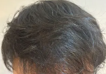 レバクリの発毛プラン治療後4ヶ月の症例画像