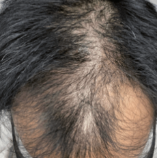 クリニックフォアの発毛ベーシックプラン治療前の症例画像