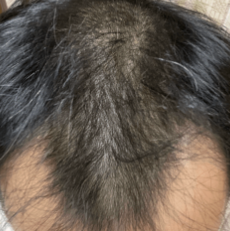 クリニックフォアの発毛ベーシックプラン治療後2ヶ月の症例画像